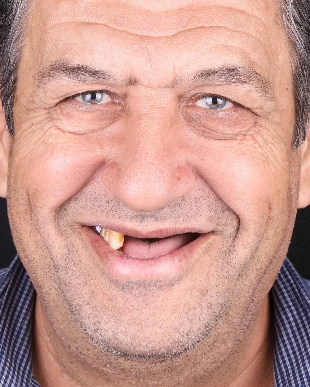 الحالة الثالثة قبل العلاج