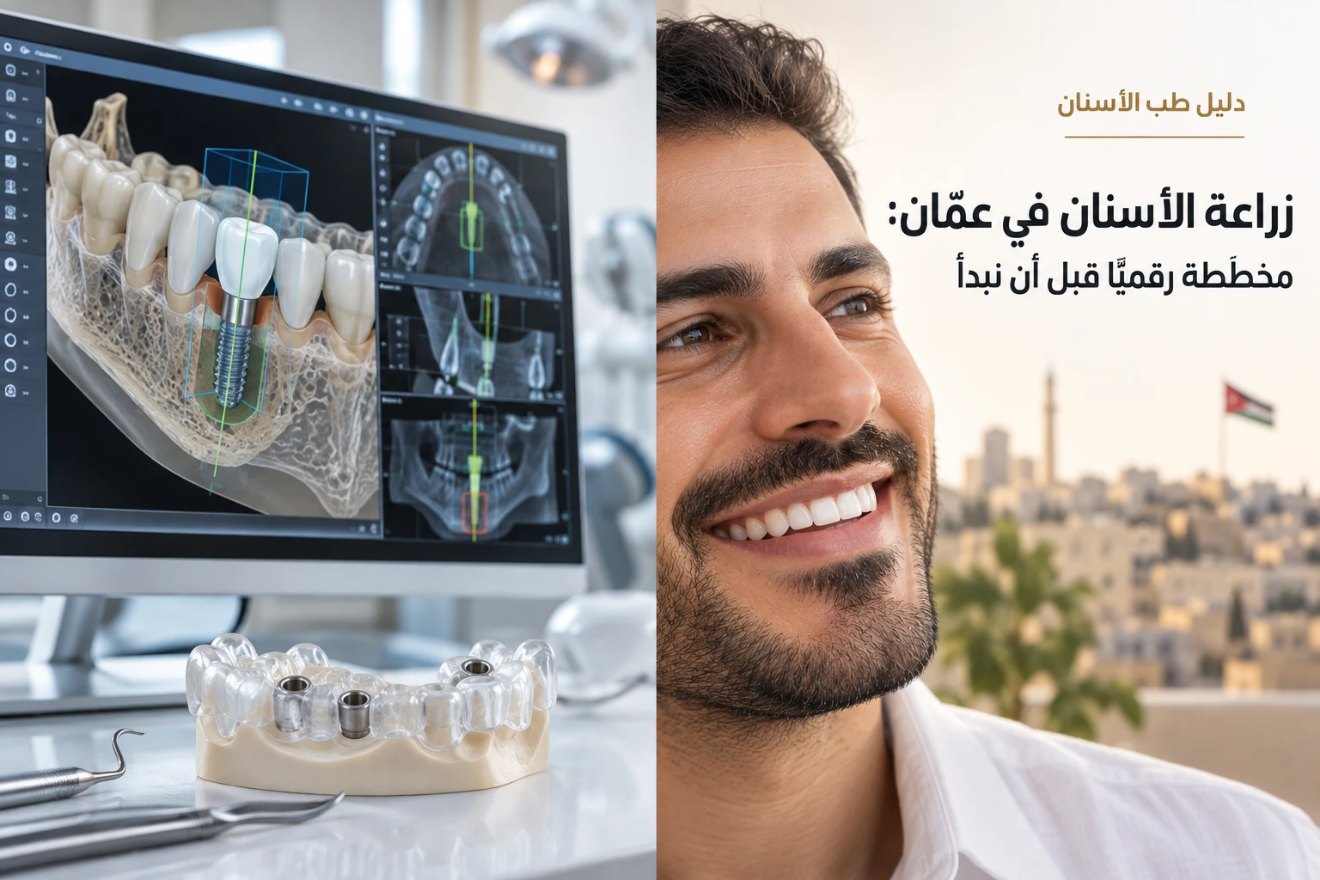 دليل طب الأسنان: شاشة تخطيط زراعة رقمي ونموذج فك بدليل جراحي، بجانب رجل يبتسم وخلفه عمّان، بعنوان «زراعة الأسنان في عمّان: مخطَّطة رقمياً قبل أن نبدأ»